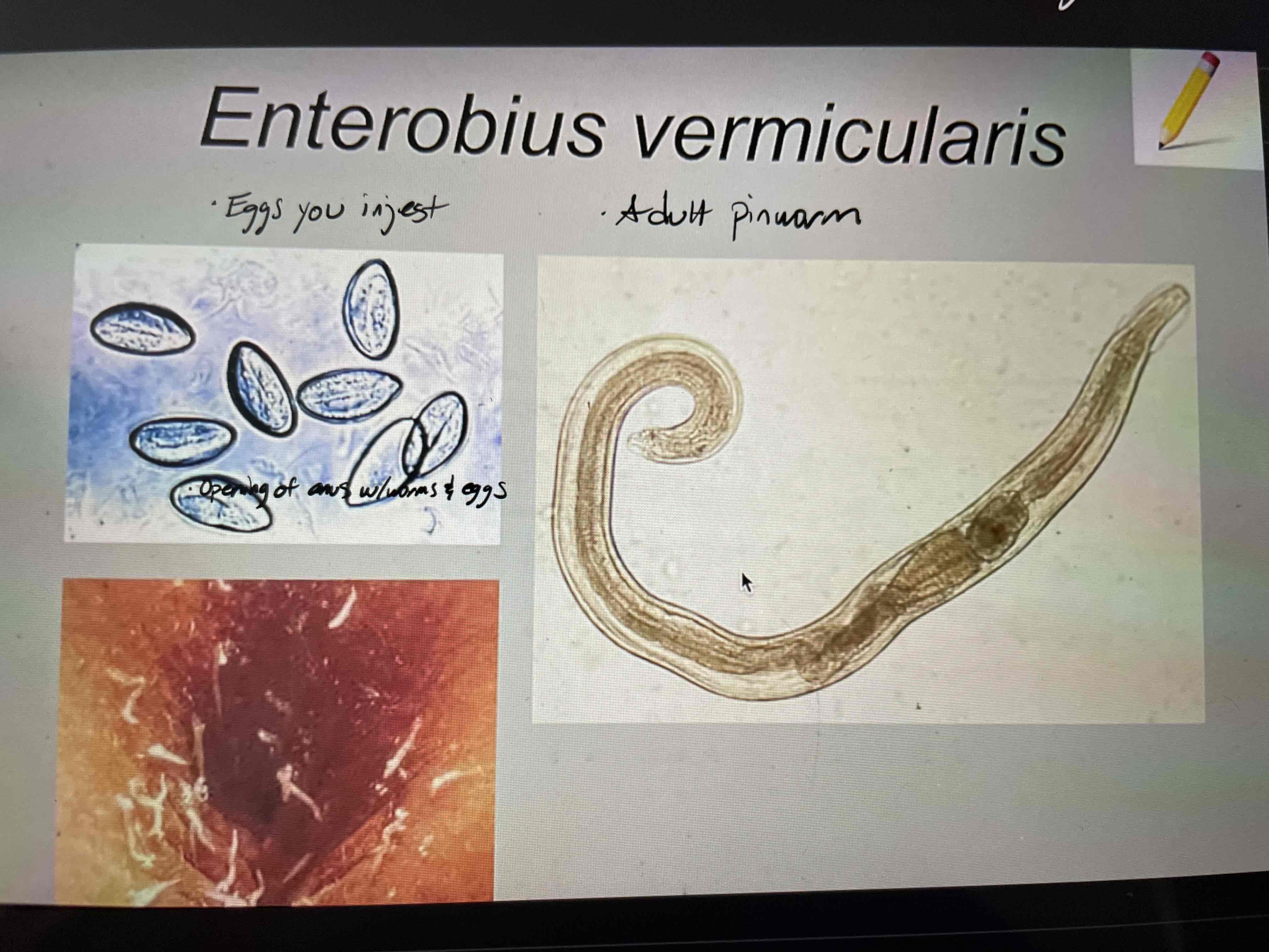 <p><strong>Type: </strong>helminth, pinworm</p><p><strong>Disease:</strong> enterobiasis - intestinal infection, nocturnal anal itch</p><p><strong>Pathogenesis:</strong></p><ul><li><p>Eggs ingested and hatch in duodenum</p></li><li><p>Females emerge at night and lay eggs around anus → <u>itching</u></p></li></ul><p><strong>Treatment:</strong> mebendazole (oral anti-helminth drug)</p><p></p>