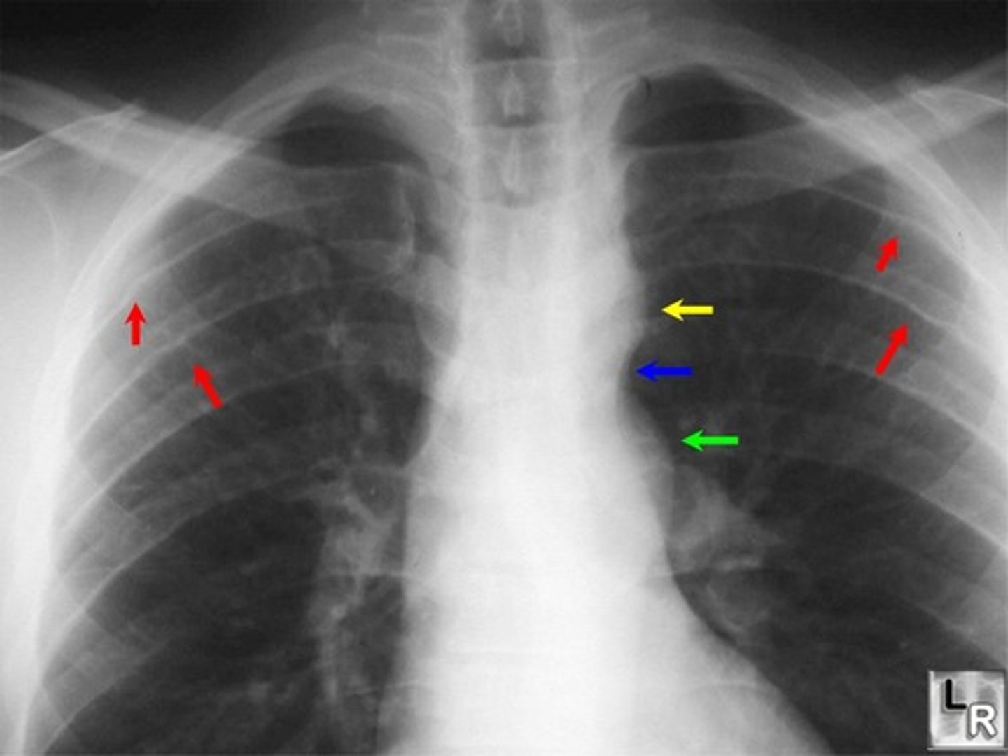 <p>- cardiac enlargement</p><p>- pulmonary venous congestion</p><p>- figure 3 sign</p><p>- inferior notching of the ribs</p>