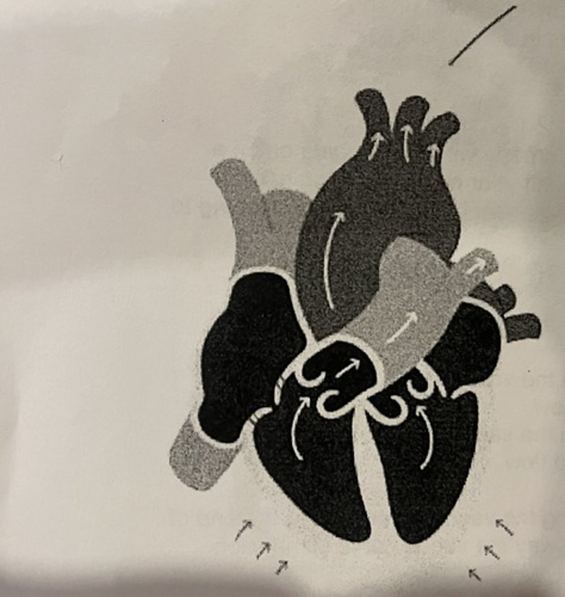 <p>Decreased stroke volume to the pulmonary artery</p>