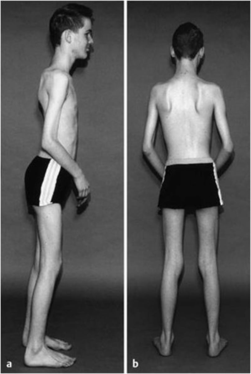 <p>Symptoms include contractures before muscle weakness, toe walking, increased falls, and elbow contractures at a 90-degree angle.</p>