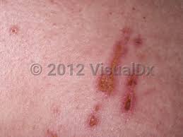 <p><span>An erosion or ulcer caused by scratching.</span></p>