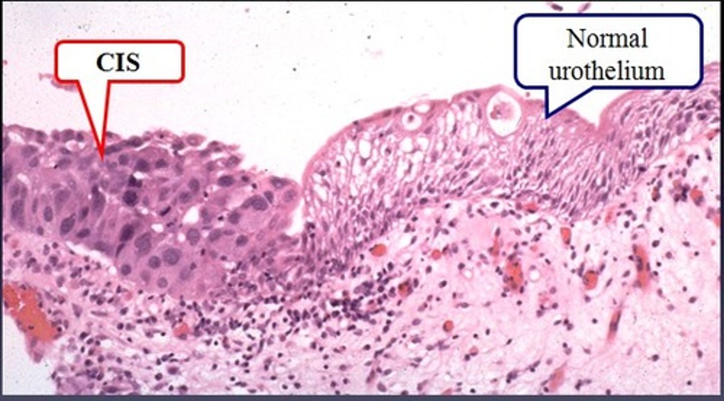 <p>Preinvasive epithelial malignant tumors of glandular or epithelial origin that have not broken through the basement membrane or invaded the surrounding stroma</p>