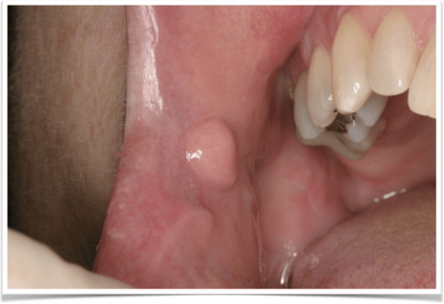 <p>fibrous hyperplasia</p>