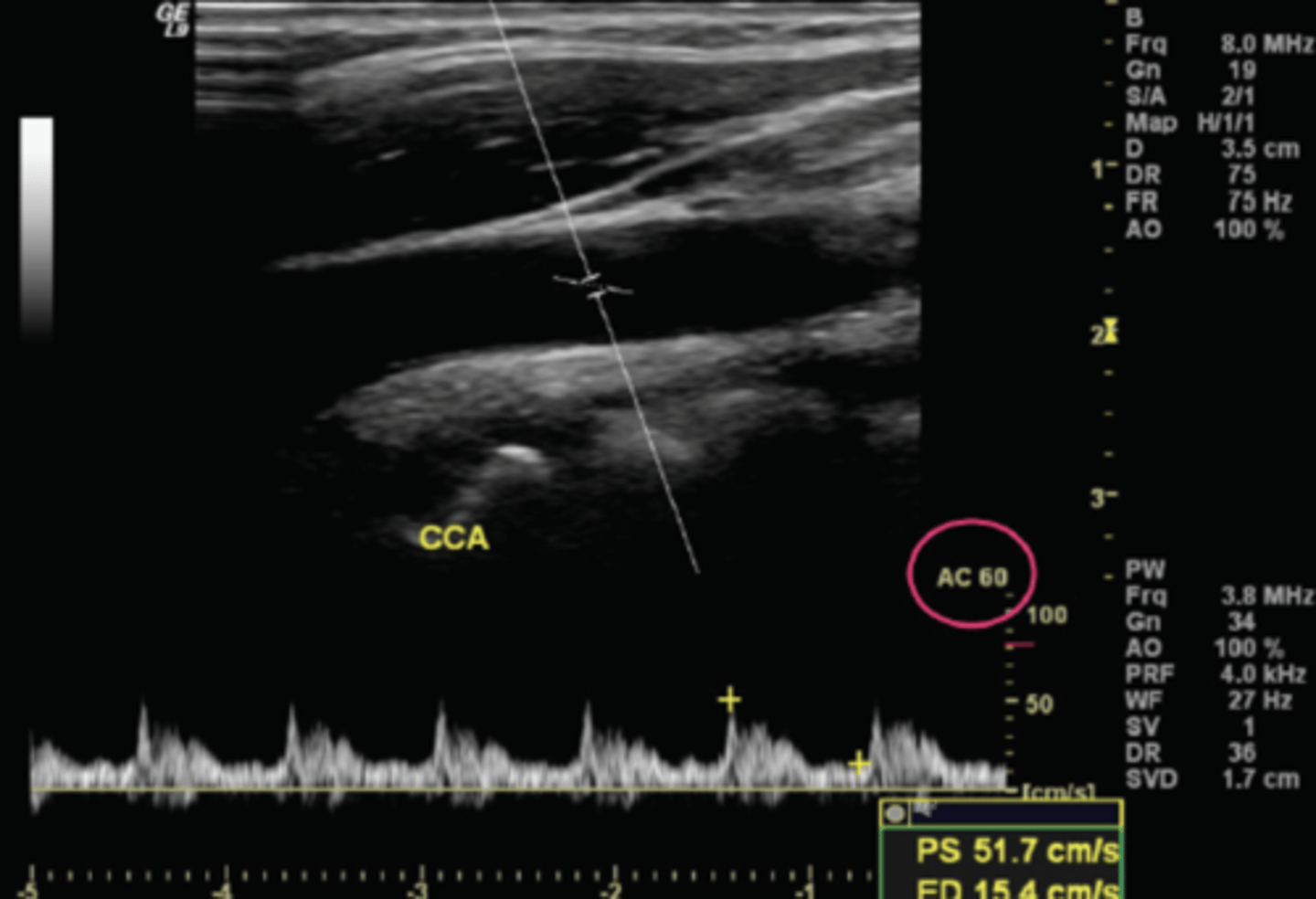 <p>Can result in over/underestimated peak velocities</p>