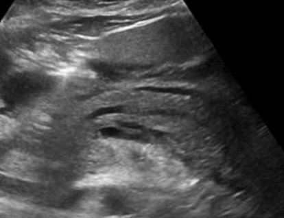 <p>Swelling, fluid around the pancreas, increase in size</p>