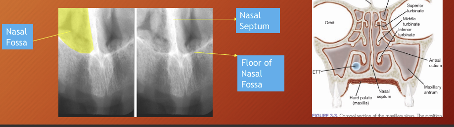 <p>the nasal septum divides the nasal cavity into 2 fossae</p>