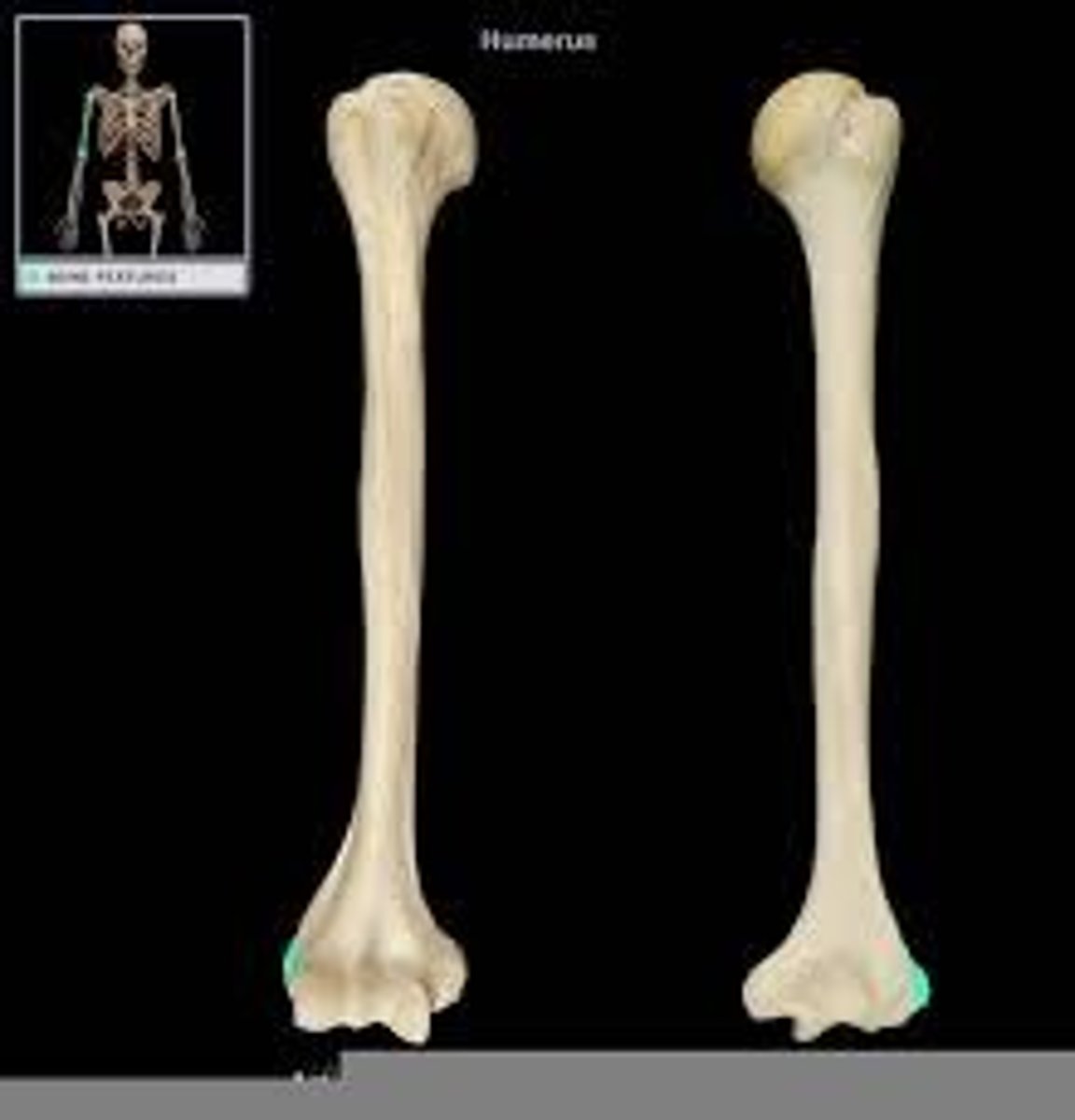 <p>Bony mass proximal to the capitulum and trochlea</p>