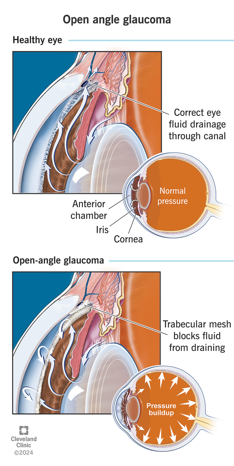 <p>PP: optic nerve dx→nerve cell/neuron death→gradual loss of peripheral vision</p><p>E: leading cause of visual imapirment+blindness in US<br>3 million adults<br>50%→unaware</p><p>RF: 65+ y/o<br>black<br>diabetes<br>myopia<br>ocular hypertension (IOP 21+ mmHg)</p><p>CM: asx <strong>(no pain)</strong><br>gradual loss of peripheral vision</p><p>DX:<br>american academy of opthalmology:<br>-baseline examination→40 y/o<br>-at-risk→earlier<br>-known FHx→earlier</p><p>PE: optic cup enlargement (glaucomatous cupping)</p>