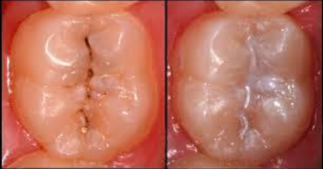 <p>suitable for non-cavitated occlusal or proximal lesions (caries only in enamel)</p>
