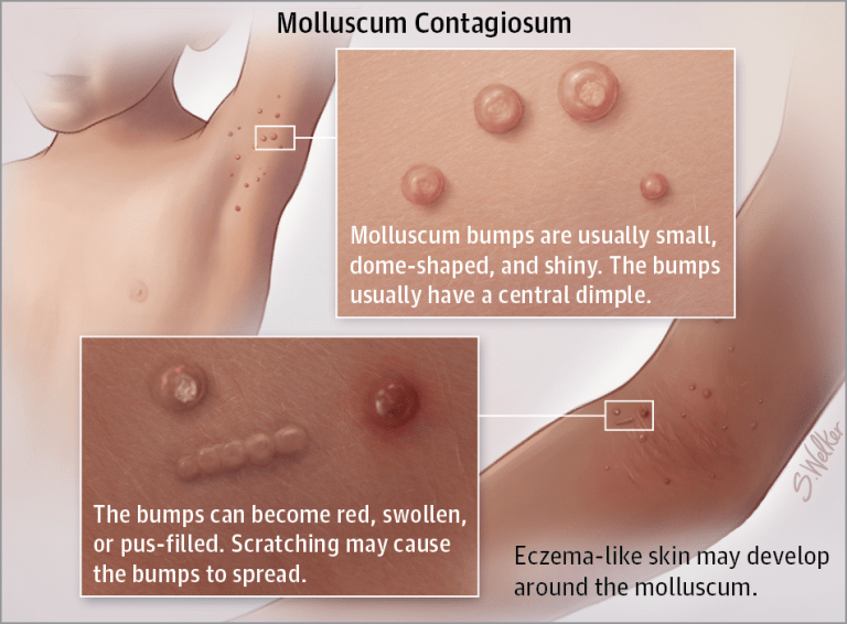 <p>•Failure to thrive, neurodevelopmental delay, lymphadenopathy, Opportunistic infections (thrush, diaper rash), interstitial pneumonitis, frequent diarrhea, hepatosplenomegaly</p><p><strong>-molluscum contagiosum</strong> </p><p>(benign viral skin infection<strong>)</strong></p>