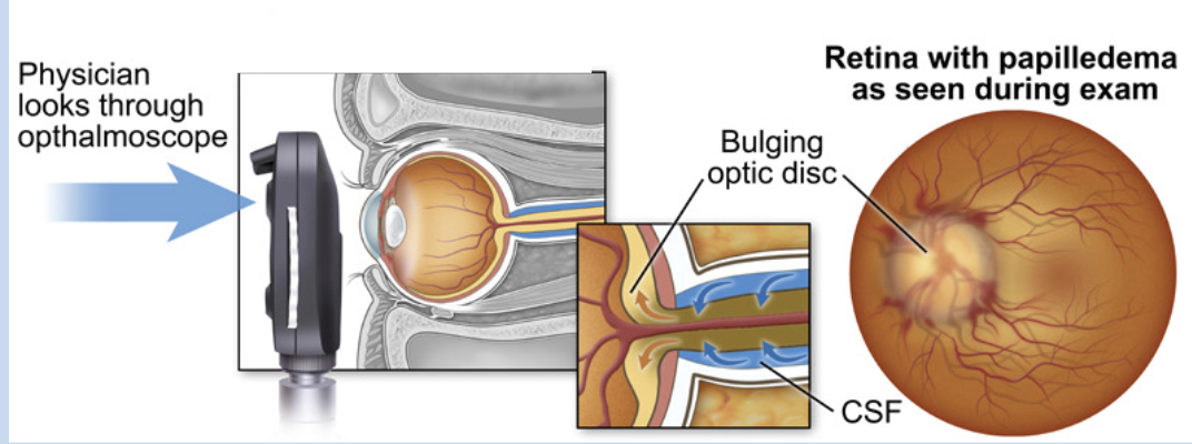 <p>papilledema</p>
