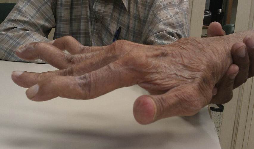 <p>What is the deformity seen in the image below? What can it be caused by? </p>