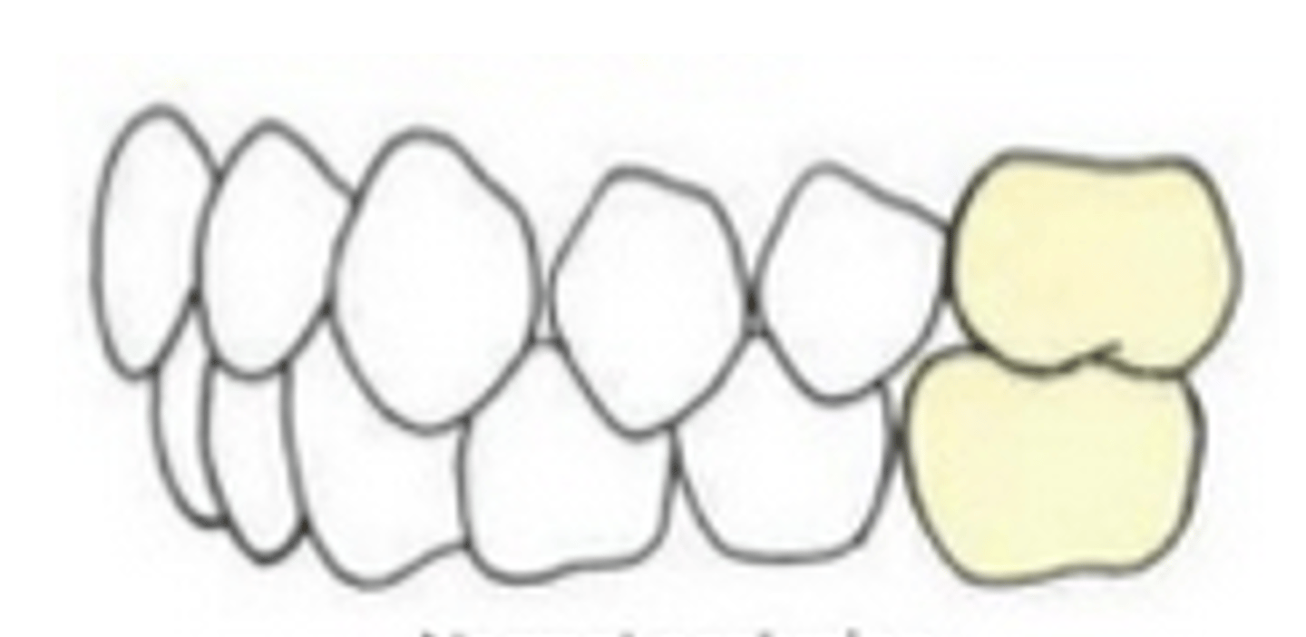 <p>ID the class of occlusion:</p>