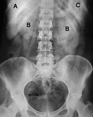 On the radiograph shown, the letter "A" indicates the: