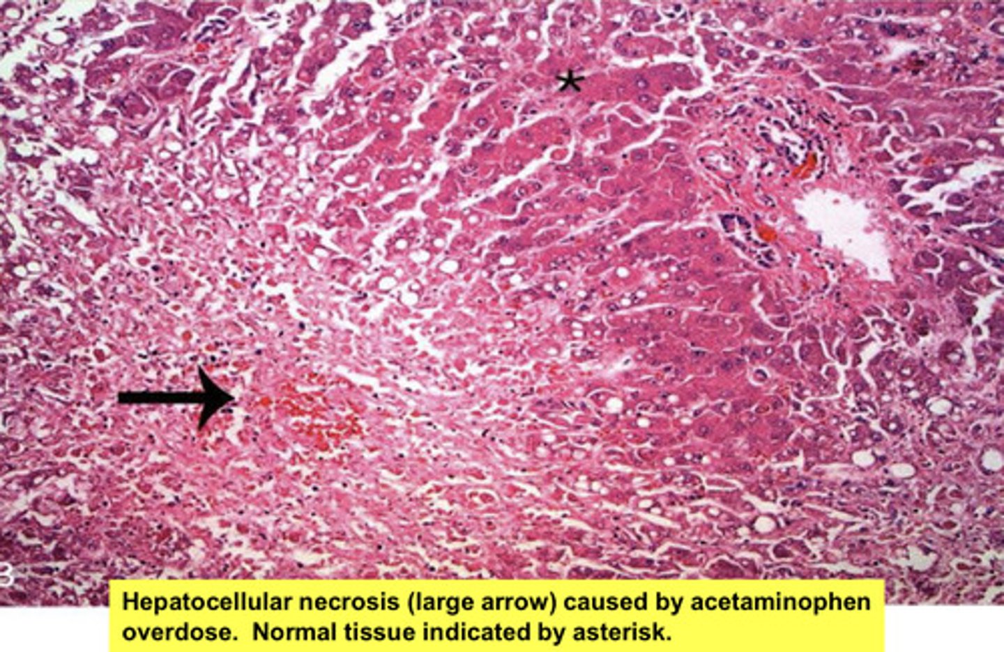 <p>pale, yellow scarring, coagulative necrosis, inflammation</p>