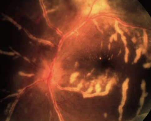 <p>What would see on a funduscopic exam of a pt w/ CMV retinitis?</p>