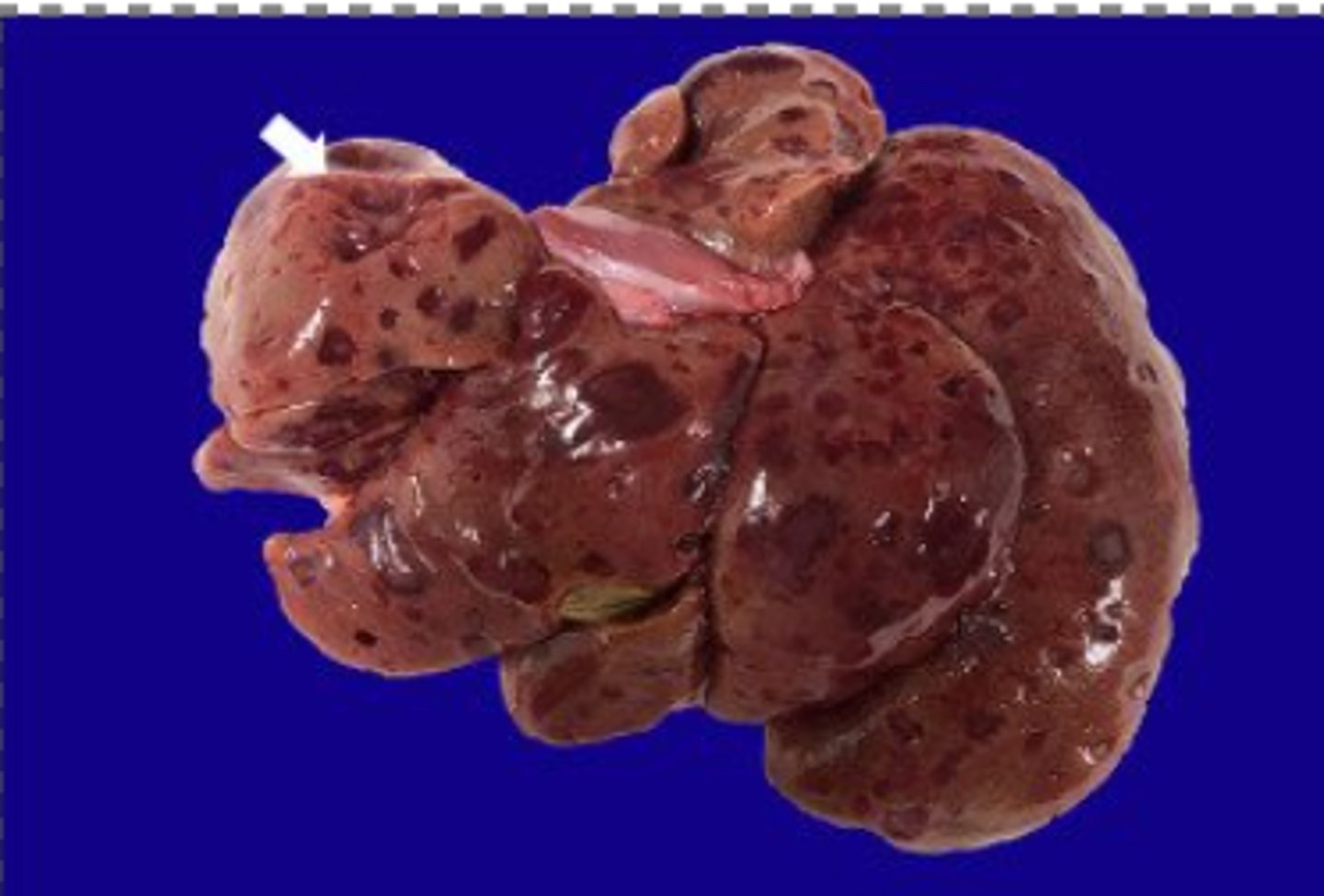 <p>What has caused this gross appearance of the liver?</p>