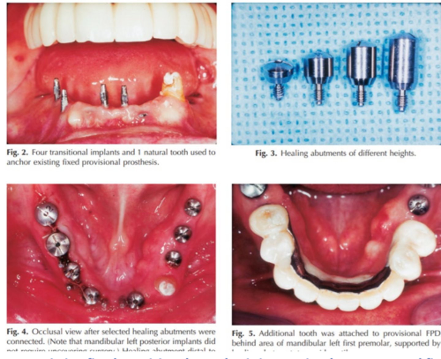 <p>This image shows transformation of an existing fixed provisional prosthesis into an implant-supported fixed provisional prosthesis with the use of _________</p>