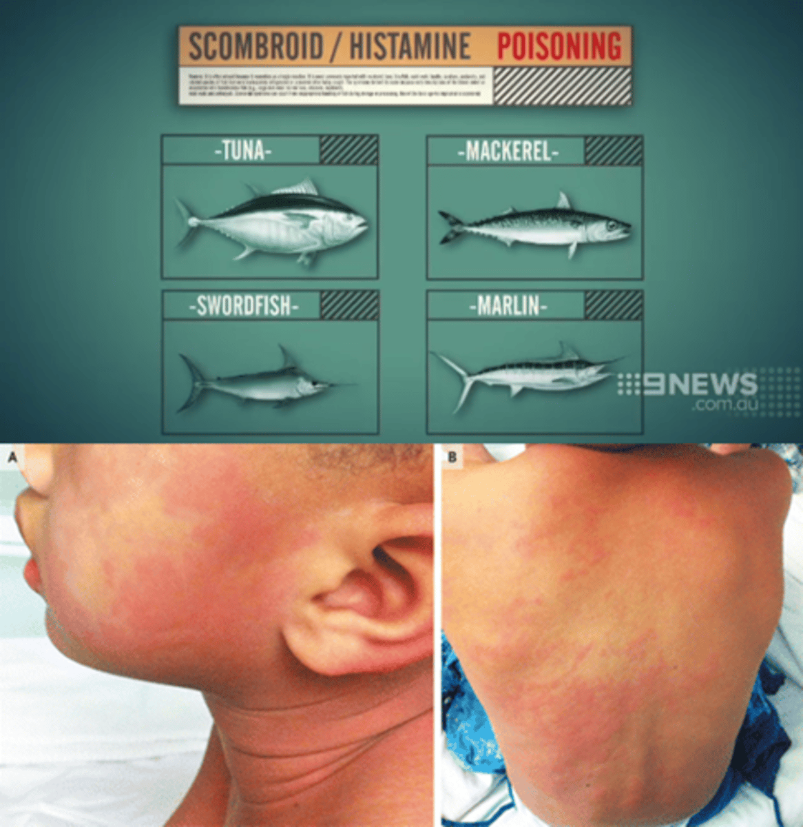<p>Scombroid poisoning</p><p>(vs. acute allergic reaction: no similar symptoms in the patient's friends)</p>