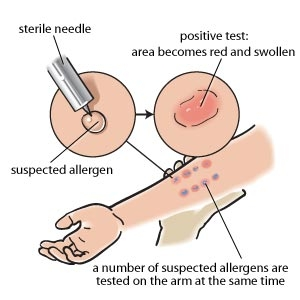 <p>Inject recall antigens into superficial skin layer with a needle</p><p>To evaluate the patient’s immune system</p>