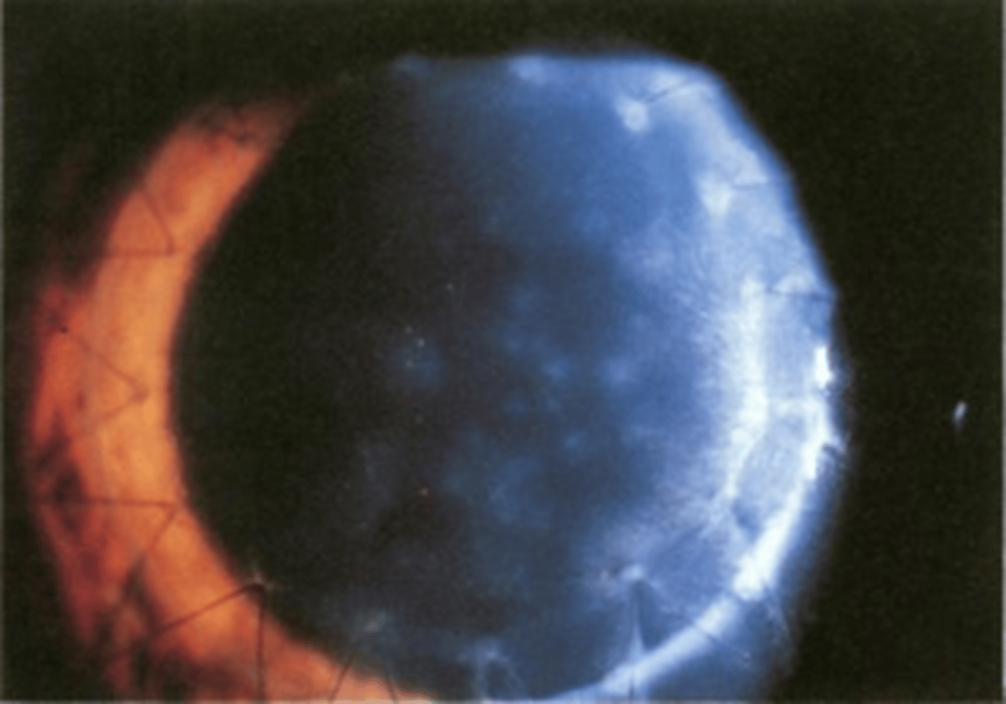 <p>What sign of graft rejection, a complication of PKP, is seen here?</p>