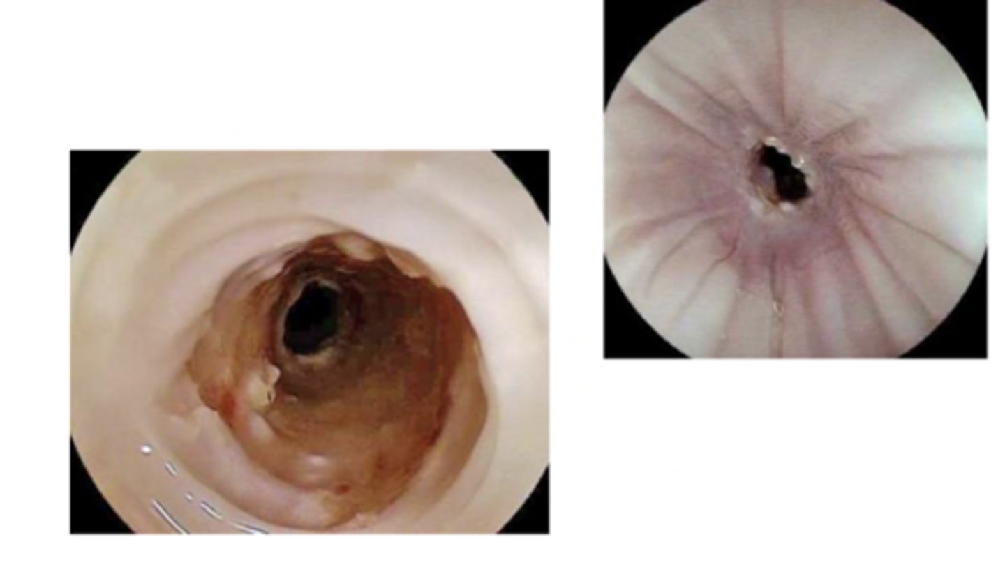 <p>How do you diagnose esophageal stricture?</p>