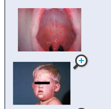 <p>Rubeola (Measles)</p>