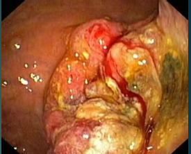 <p><strong>Gastric Carcinoma: Diagnosis</strong></p><p>-___________ → most sensitive and specific for diagnosis </p><ul><li><p>______ needed for confirmation</p></li><li><p>EUS to determine the local extent of primary tumor </p></li></ul><p>-Chest/Abdominopelvic CT</p><ul><li><p>Performed early after dx is made </p></li><li><p>Evaluate for _________ disease </p></li></ul><p>-PET Scan → can confirm malignant involvement if CT detected ___</p><p>-Laparoscopy → advantage of directly visualizing abdomen </p><p></p>