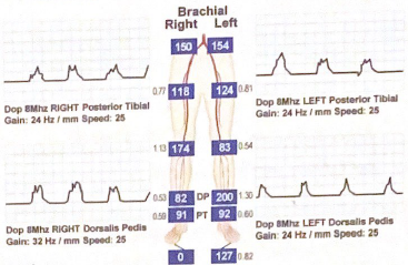 <p>Describe the left dorsalis pedal artery waveform pattern and categorize the severity of the ABI</p>