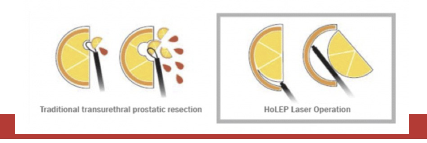 <ol><li><p>holmium laser enucleation of the prostate</p></li><li><p>A laser is used to remove obstructing prostate tissue (cut the whole thing once)</p></li><li><p>less bleeding and more effective for large prostate</p></li></ol><p></p>
