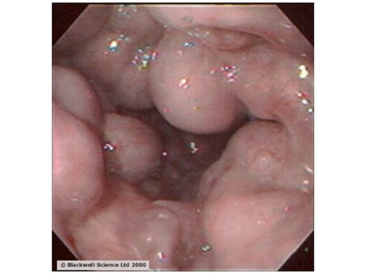 <p>dilated veins caused by liver cirrhosis<br>- scarring causes a backflow of blood into veins, keeping them dilated and enlarged<br>- can "pop" and cause severe internal bleeding</p>