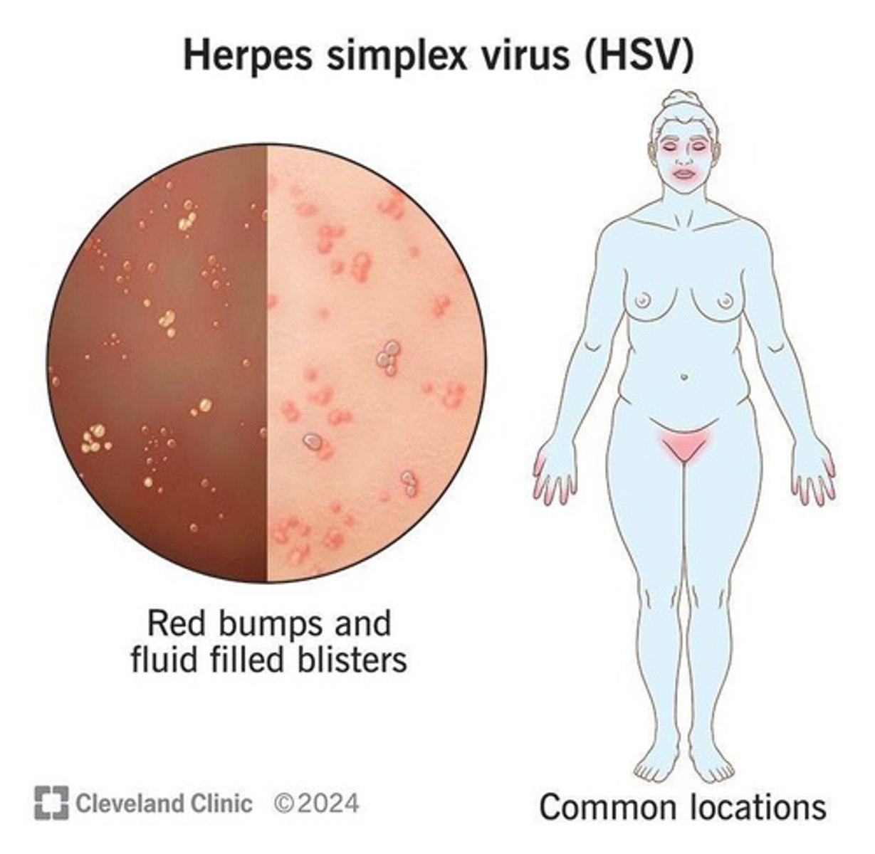 <p>The cause of oral herpes (cold sores) and genital herpes, which are more frequent and severe in immunosuppressed individuals.</p>