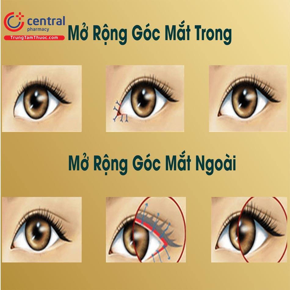 <p>phẫu thuật mở góc mắt trong</p>
