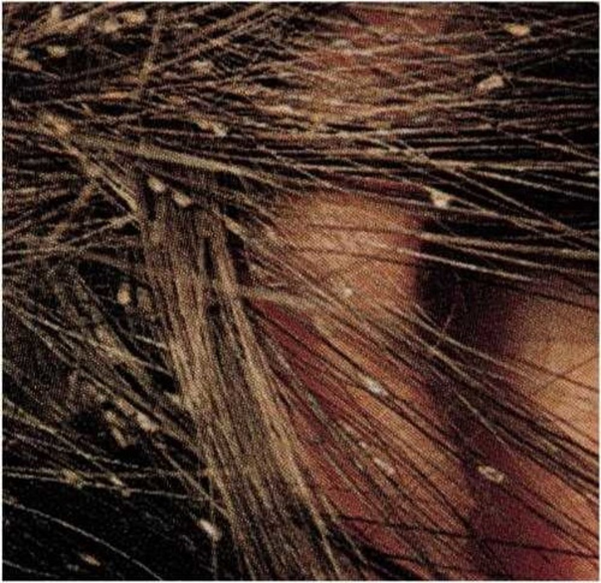 <p>Within 6mm of scalp (nits >6mm from scalp are likely old/hatched and don’t indicate active infestation)</p>