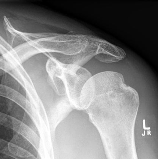 <p>what projection best demonstrates the hill sachs defect</p>