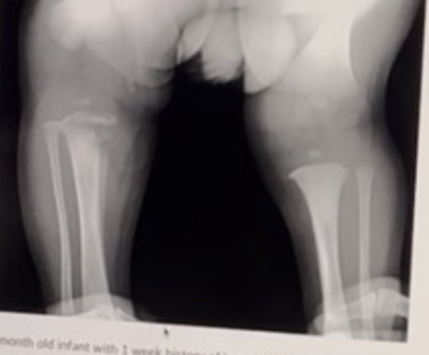 <p>10 month old infant with 1 week history of knee pain and swelling.</p><p>The most likely diagnosis is:</p>