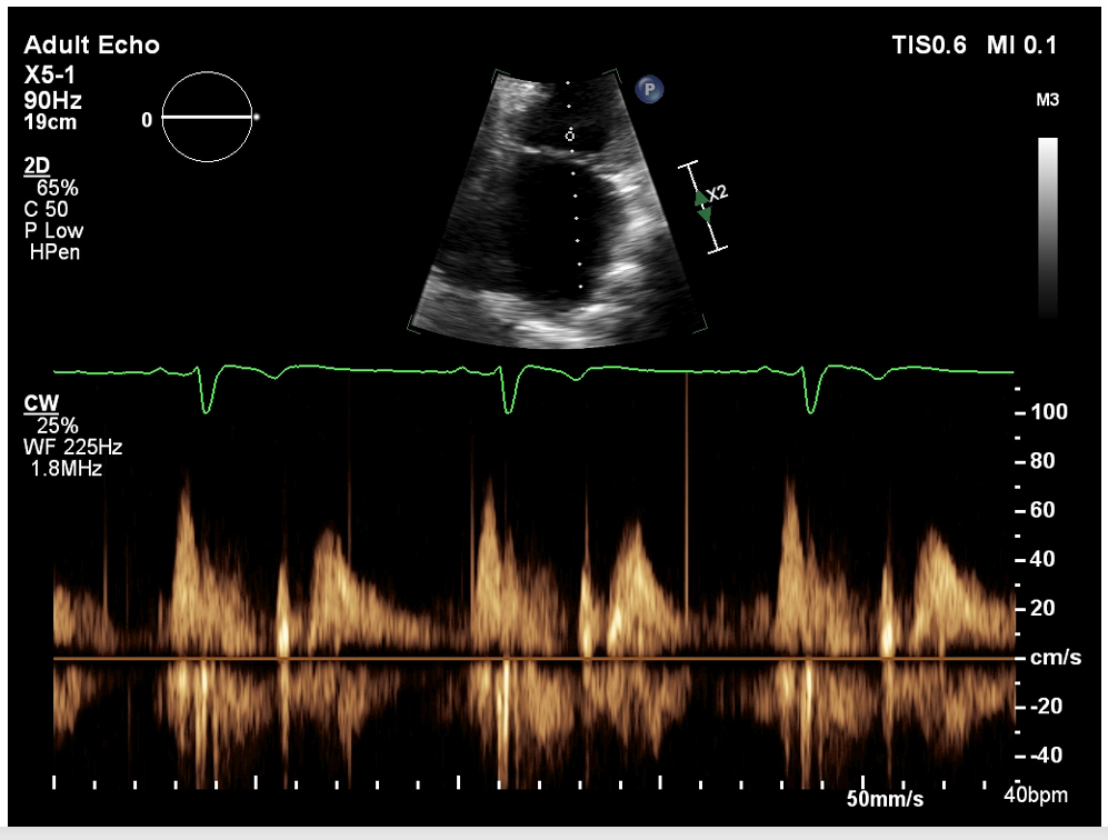 <p>correctly obtain CW doppler for MS (scale at 6) show above the baseline (compression at 12)</p>