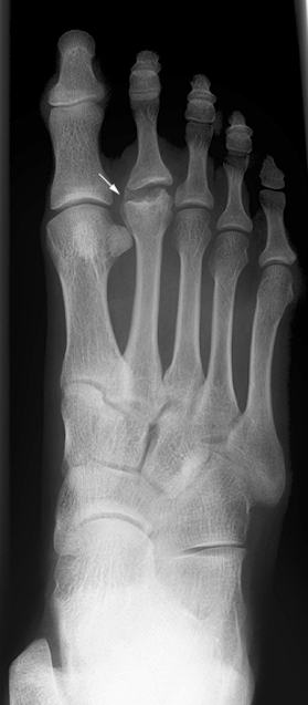 <p>What bone is affected in Freiberg’s disease?</p>