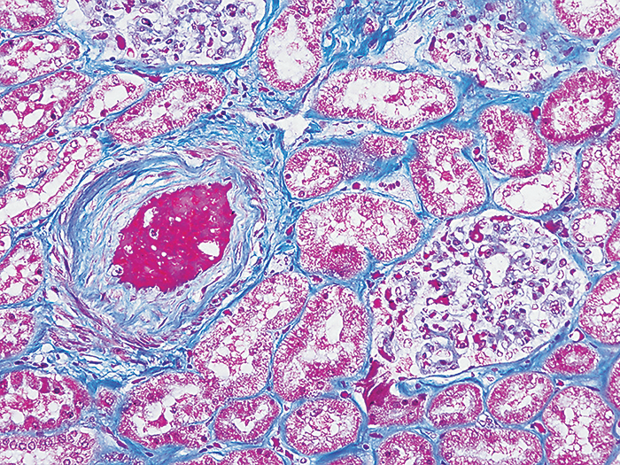 <p>Stains</p><ul><li><p>Basophilic structures → dark blue</p></li><li><p>collagen → green/light blue</p></li><li><p>Cytoplasm, keratin, muscle, and erythrocytes/Red Blood Cells (RBC) → red</p></li></ul><p></p>