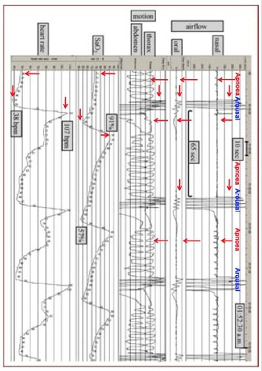 <p>Records continuous airflow by a nasal cannula pressure transducer, nasal and oral airflow via a thermistor, rib cage &amp; abdominal motion for breathing efforts, arterial O2 saturation &amp; heart rate by pulse finger oximetry, and synchronized, single- or multichannel ECG.</p>