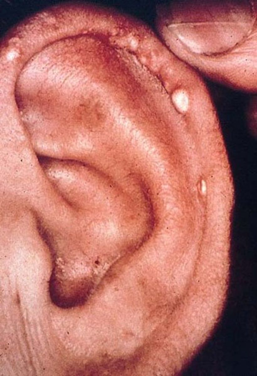 <p>Uric acid crystal deposit - dt chronic tophaceous gout</p><p>Hard nodules on helix/antihelix</p><p>May discharge - white chalky crystal</p>