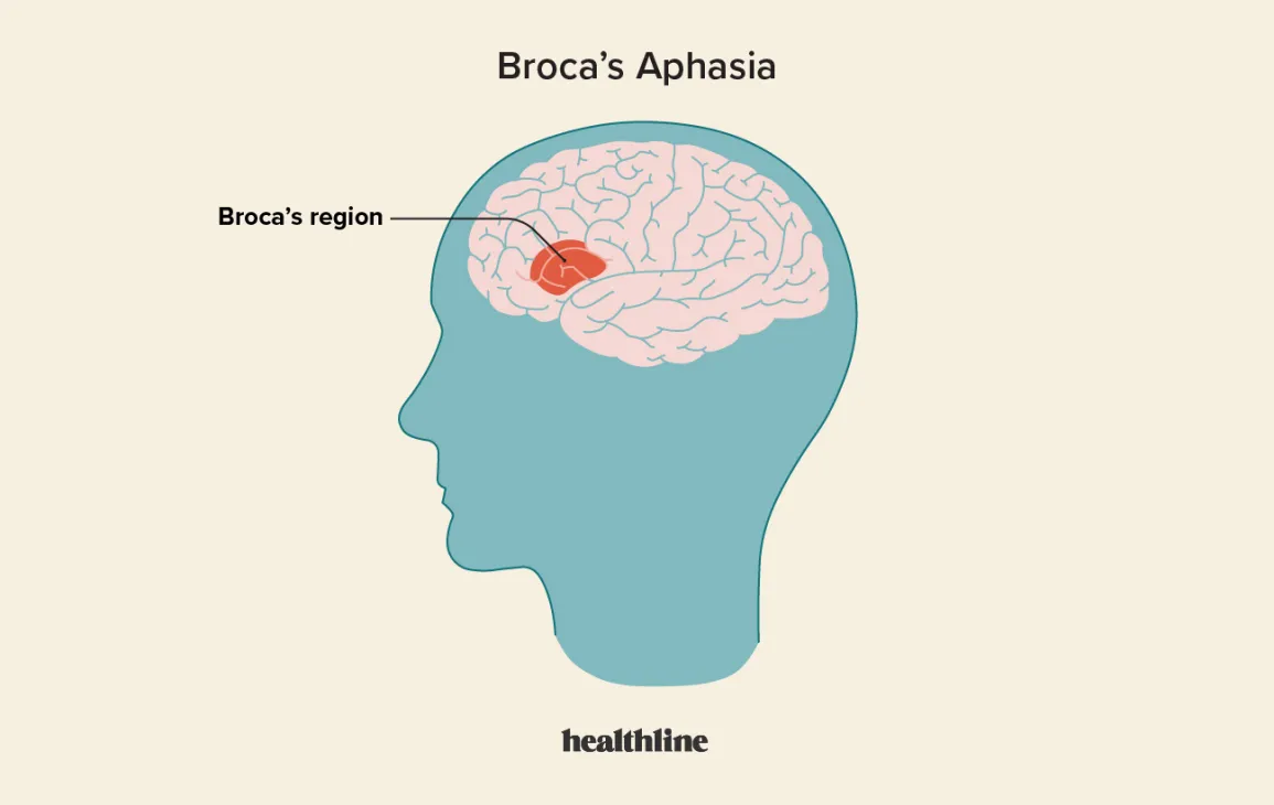 <ul><li><p>inferior frontal gyrus </p></li><li><p>one hemisphere, located in the left frontal lobe</p></li><li><p>damage results in Broca’s aphasia </p><ul><li><p>expressive language impairment </p></li></ul></li></ul>
