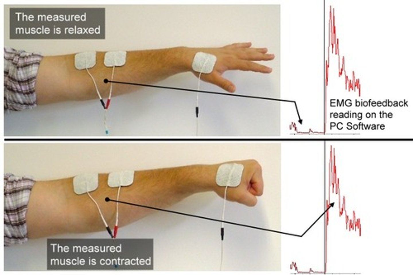 <p>Low sensitivity for muscle relaxation and close together</p><p>(other terms may be used: inhibition, decrease tone/activity, downtrain)</p><p>High sensitivity for muscle re-education and far apart</p><p>(other terms may be used: facilitate, activation, recruitment, up train)</p>