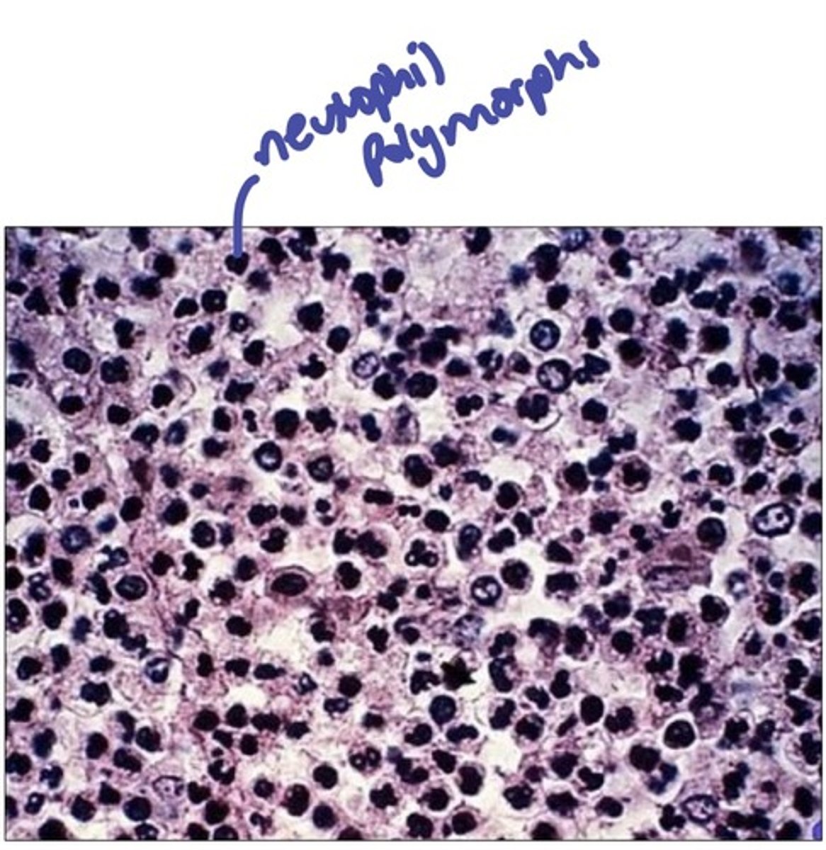 <p>by looking for the presence of neutrophil polymorphs</p>