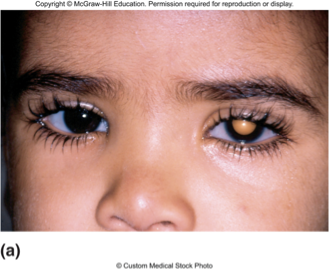 <p><span>•Caused by mutations in RB gene</span></p><p><span>•Inheritance of one RB<sup>−</sup> copy predisposes to cancer of retina</span></p><p><span>•Often tumors of both eyes</span></p><p><span>•During proliferation of retinal cells, RB<sup>+</sup> allele is lost or mutated</span></p><p><span>•Tumors develop as clone of RB<sup>−</sup>/RB<sup>− </sup>cells</span></p><p><span>a childhood eye cancer characterized by abnormal cell growth in the retina, typically associated with mutations in the RB1 gene. </span></p>