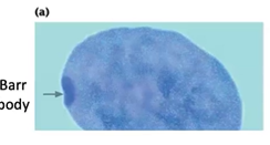 <p>inactivated, highly condensed X chromosome</p>