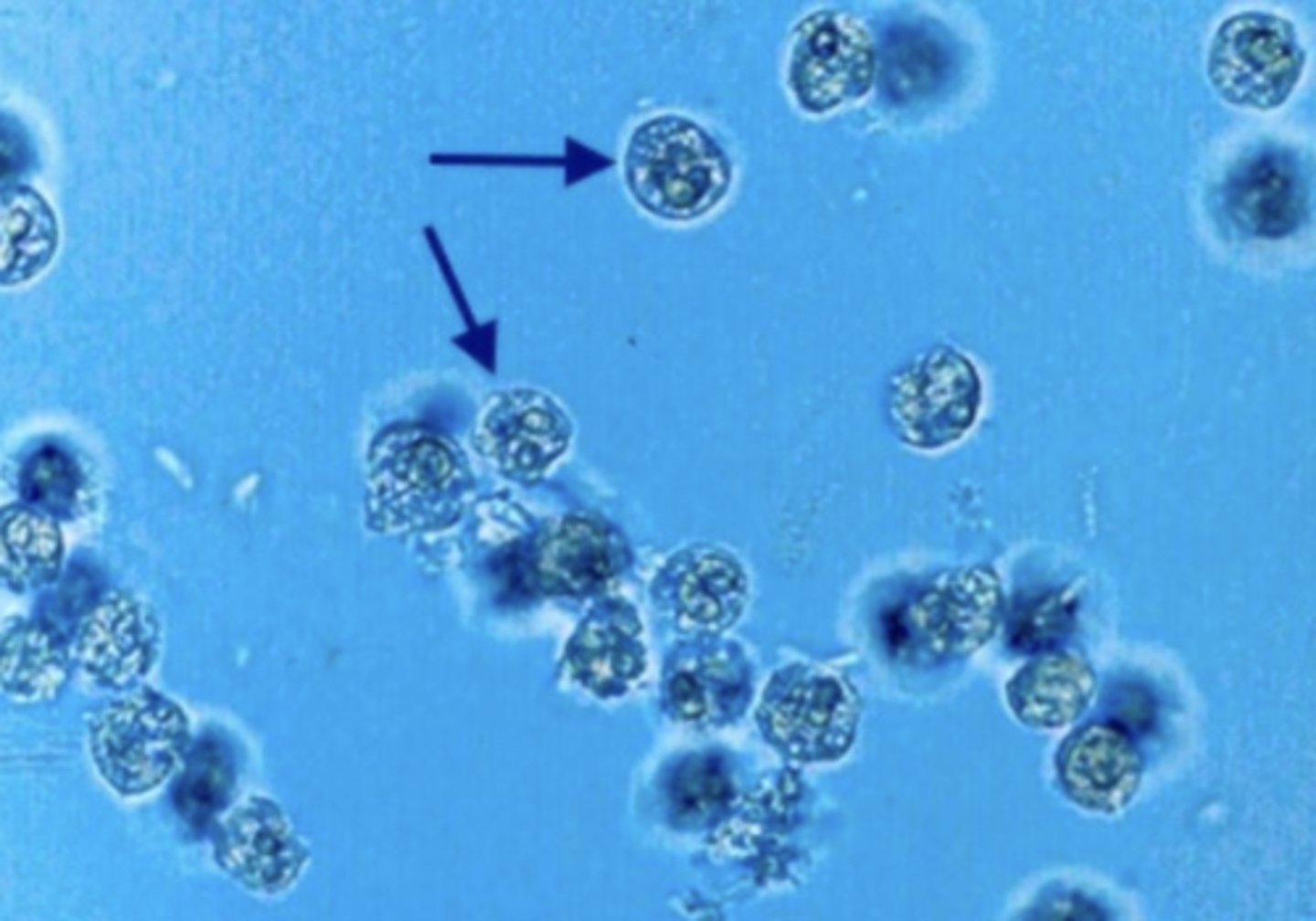 <p>swell in dilute alkaline urine, and the cytoplasmic granules exhibit Brownian movement, resulting in "glitter cells." These cells lyse rapidly. "Glitter cells" are most easily seen when viewed under phase-contrast microscopy.</p>