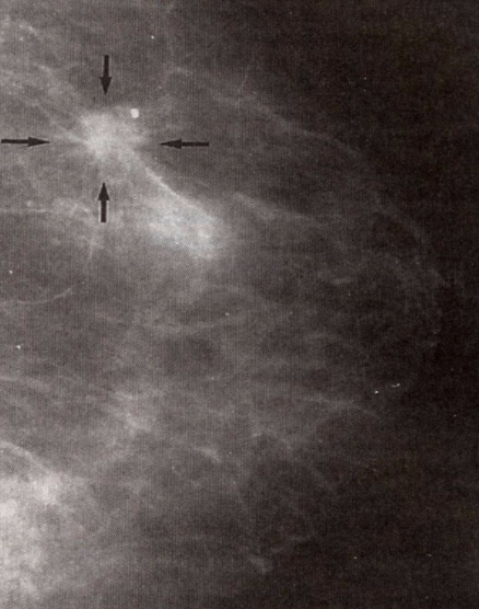 <p>Breast Cancer Microcalcifications</p>