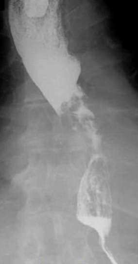 <p>What esophageal disorder is this?</p>