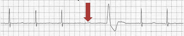 <p>come late in the cardiac cycle, past when next expected R wave; wide QRS</p>